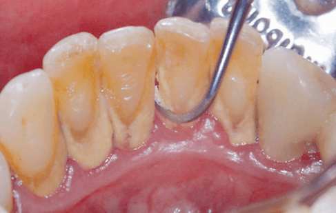 Dental plaque & Calculus
