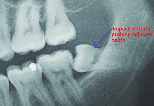 impacted-teeth-causes-pressure