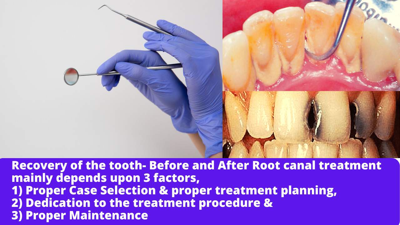 Before and After Root canal treatment, Recovery of tooth