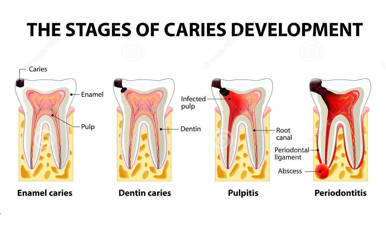 stages caries development dental disease pulpitis periodontitis 68859039