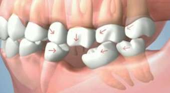 Missing tooth can cause Shifting of teeth position