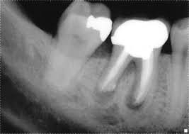 Failed Root Canal Treatment