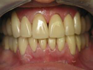 Yellow Teeth- Know Cause, Prevention & Treatment