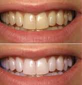 Yellow teeth after bleaching