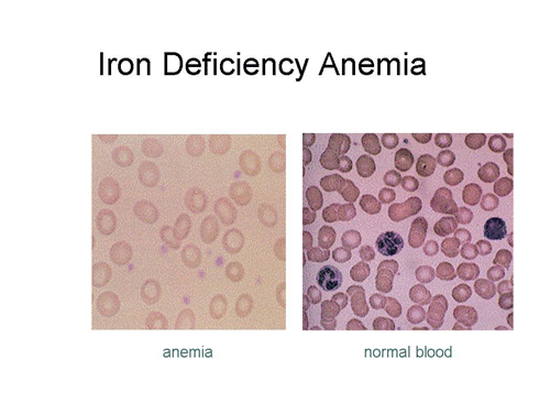 iron deficiency anemia pic