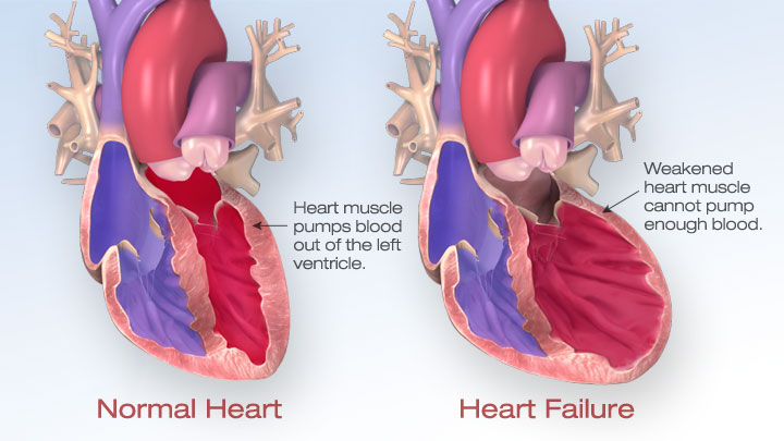 Congestive Heart failure (CHF)