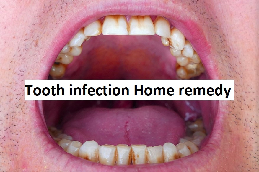 Tooth infection Home remedy