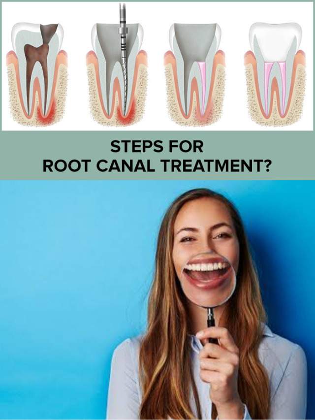 Root Canal Treatment or RCT Indications »