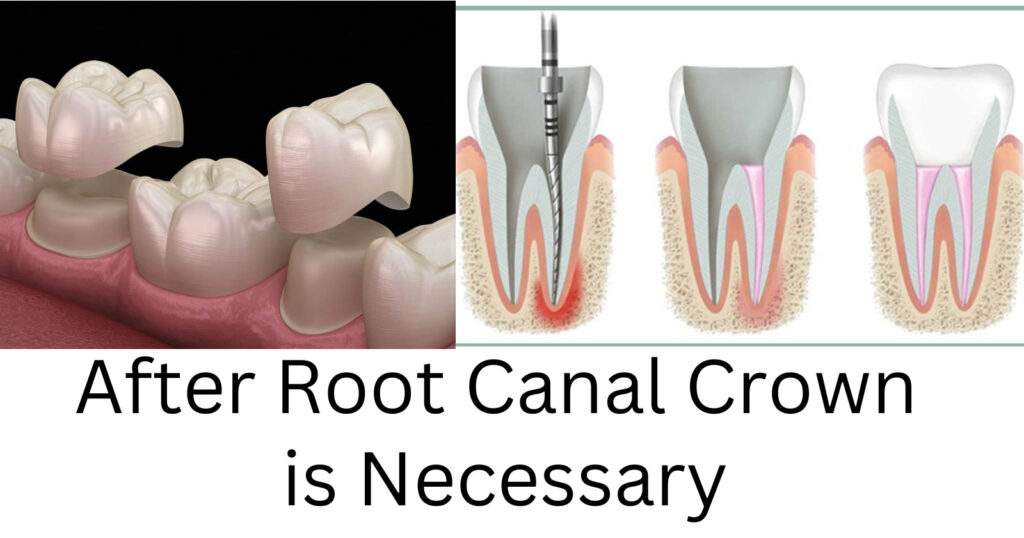 After Root Canal Crown is necessary