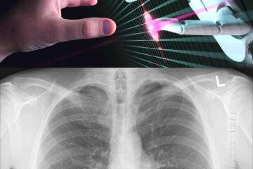 Robotic Technology help to find & Treat Lung Cancer