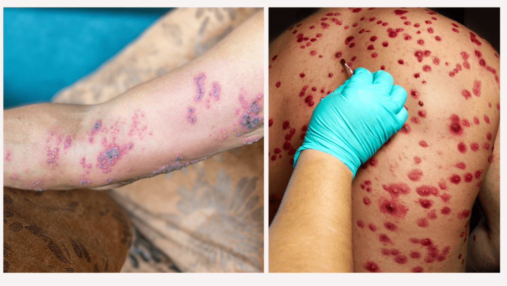 Shingles Are Contagious- Herpes Zoster