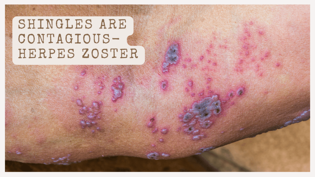Shingles Are Contagious Herpes Zoster
